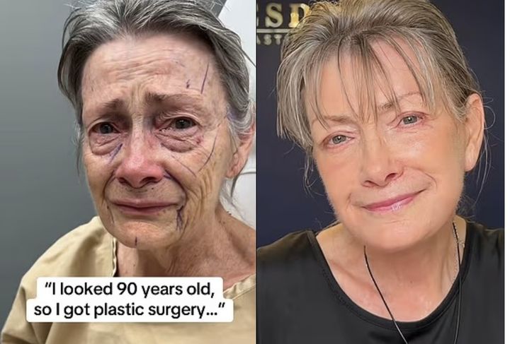 [서울=뉴시스]안면거상 수술을 받은 70세 여성의 수술 전(왼쪽)과 수술 후(오른쪽) 모습. (사진출처: 틱톡) 2026.03.19.