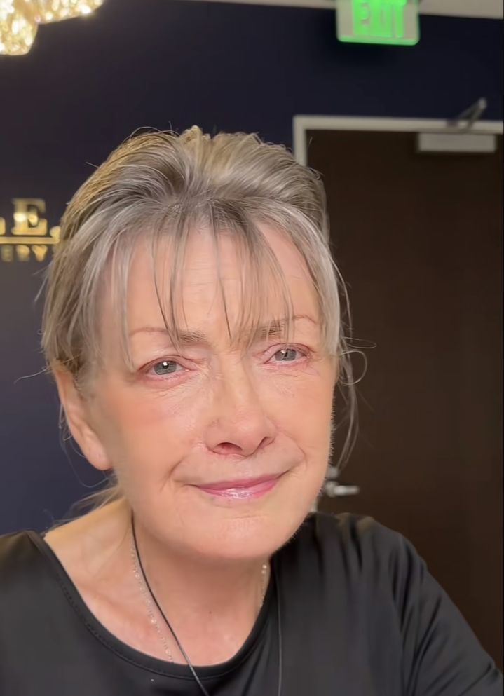 [서울=뉴시스] 여성의 안면거상술 후의 모습. (사진=틱톡 'doctor.trusedale' 캡처) *재판매 및 DB금지 *재판매 및 DB 금지