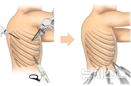 [서울=뉴시스] 기존 흉강경 폐암 수술법(좌)과 늑간 보존 로봇 폐암 수술법(우)의 비교. (사진= 분당서울대병원 제공)