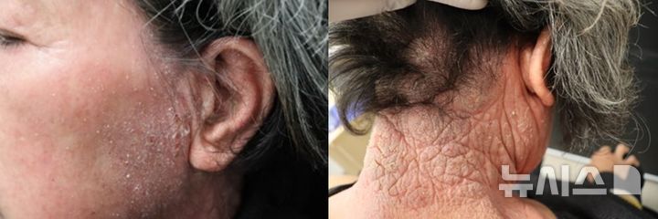 [서울=뉴시스] 지루피부염은 두피, 얼굴, 가슴 등 피지선이 많은 부위에 붉은 홍반과 함께 건성 또는 기름기가 있는 각질(인설)이 나타나는 것이 특징이다. (사진= 중앙대학교광명병원 제공)