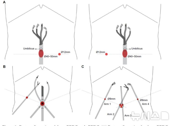 [서울=뉴시스] A는 단일공 로봇수술, B는 기존 다공 로봇수술. (사진= 고려대안산병원 제공)