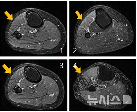 [서울=뉴시스] 근육 손상이 진행되는 과정을 단계별로 보여주는 MRI 사진. (사진= 한림대춘천성심병원 제공)