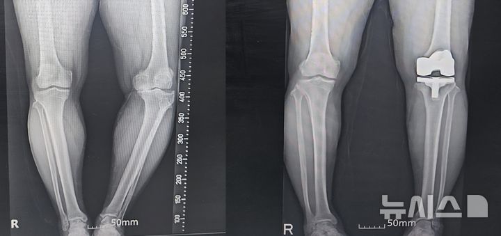 [서울=뉴시스] 퇴행성관절염과 내측변형으로 무릎이 틀어진 상태. AI와 3D모델링을 이용한 수술 전(좌)과 후(우)의 모습. (사진= 연세사랑병원 제공)