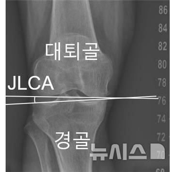 [서울=뉴시스] 무릎 관절선 수렴각(JLCA). (사진= 서울대병원 제공)