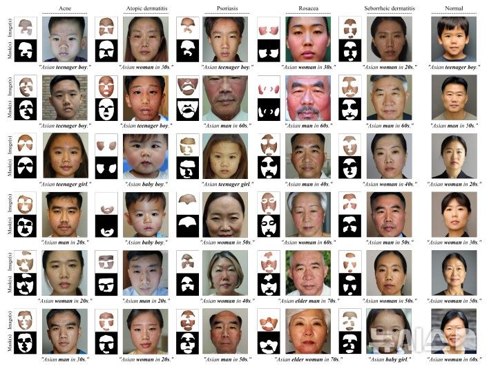 [서울=뉴시스] 피부 질환 임상 사진 적용 사례. 환자의 신원은 보호하면서도 진단에 필수적인 피부 병변(여드름, 건선 등)은 훼손 없이 보존했다. (사진= 서울대병원 제공)