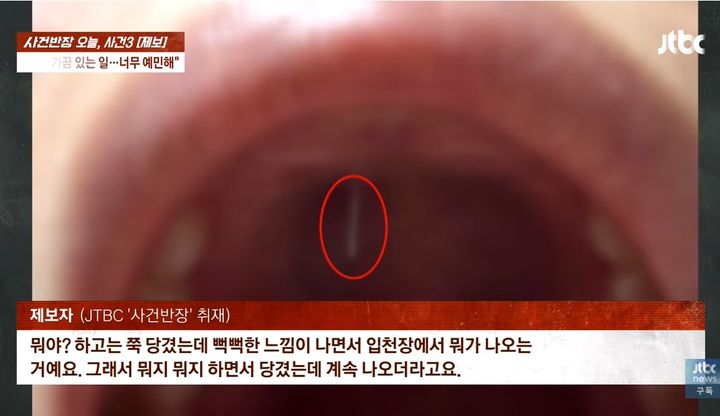 [서울=뉴시스]수 년 전 서울 강남의 한 성형외과에서 코 성형수술을 한 40대 여성 A씨가 부작용을 호소하고 나섰다. 코수술할 때 코에 넣은 철심이 최근 입천장을 뚫고 나오면서다. 사진은 입천장을 뚫고 나온 철심의 모습. (사진출처: JTBC 사건반장) 2026.04.02. 