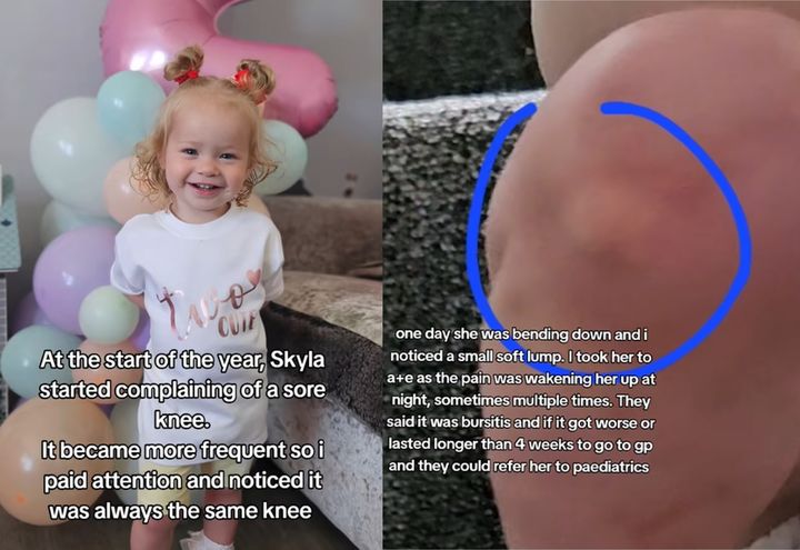 [서울=뉴시스] 단순한 성장통으로 여겼던 3살 아기의 증상이 관절염의 징조였다는 사연이 전해졌다. (사진=일레인-마리 텔퍼 틱톡 갈무리) *재판매 및 DB 금지