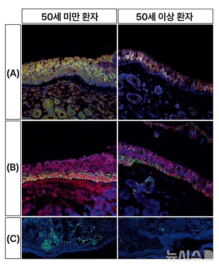[서울=뉴시스] 50세 미만 환자(좌)와 50세 이상 환자(우)의 세포 형광 염색 결과. 냄새를 감지하는 세포(A)와 후각 재생을 돕는 세포(B)는 형광으로 물든 면적이 넓을수록 세포 수가 많음을, S100(C)은 형광색이 강할수록 단백질의 발현 강도가 높음을 의미한다.(사진= 분당서울대병원 제공) 