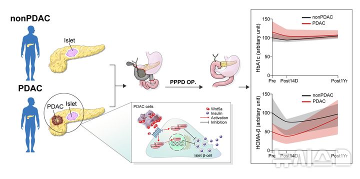 [서울=뉴시스] 췌장암 연관 고혈당과 관련 병태생리 기전 모식도. (사진= 강남세브란스 제공)