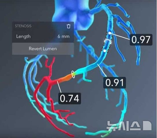 [서울=뉴시스] 심혈관 혈류 유동 결과와 유체역학 시뮬레이션 모델에 사용되는 개방형 양자 스템의 도식. (사진= 서울성모병원 제공)