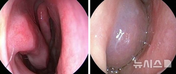 [서울=뉴시스] 정상(왼쪽)과 알레르기비염 환자의 코 점막 사진. (사진= 서울아산병원 제공)