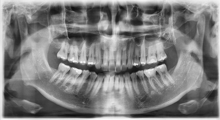 6000만 원 아끼려 튀르키예행...원정 시술 후 '치아 전부 발치'된 영국 男 - 뉴스 썸네일 이미지