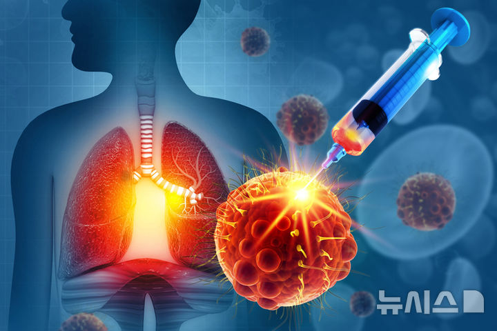 [서울=뉴시스] 국내 연구진이 폐암 표준치료에서 70세 이상 고령군과 비고령군의 치료 예후가 전반적으로 유사한 것을 확인했다. (사진= 한림대동탄병원 제공)