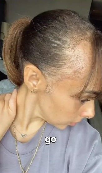 [서울=뉴시스] 미국의 한 크리에이터가 모발 이식 후 머리카락이 하얗게 변하는 부작용을 겪었다. ('dimplesqueen_niniblu' 인스타그램 계정 캡처)