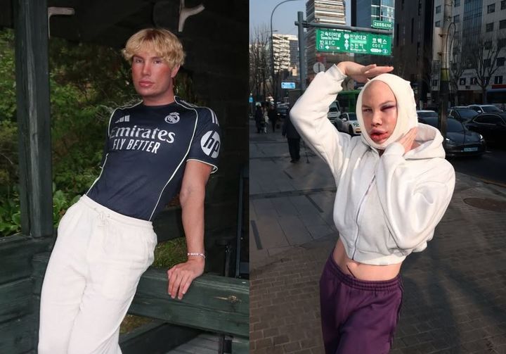 [서울=뉴시스] 지난 2월 한국에서 안면거상술을 받은 인플루언서 조니 헤셀그렌(30)은 수술 후 일시적으로 시력을 잃는 등 부작용에 시달렸다. 회복기를 가지고 있는 헤셀그렌은 "회복 과정이 예상보다 훨씬 힘들었지만 좋은 결과를 기대하고 있다"고 밝혔다. (사진=조니 헤셀그렌 인스타그램 계정 캡처)