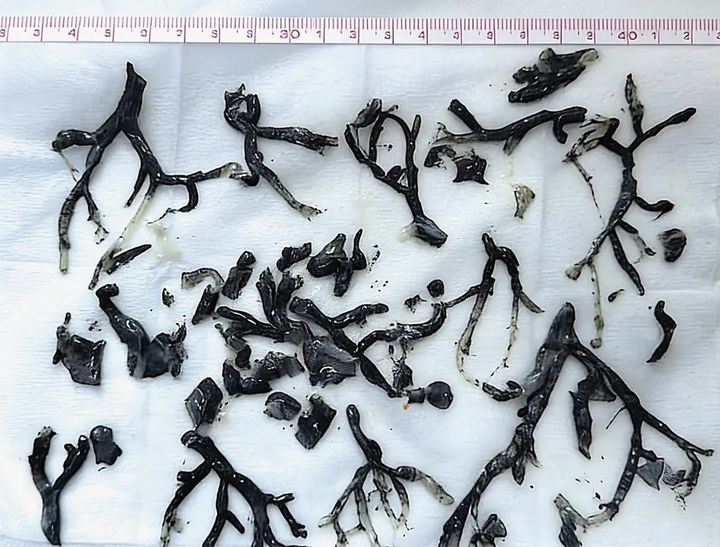 [서울=뉴시스] 미국의 한 남성이 산불 연기를 흡입한 뒤 폐에 검은 덩어리가 형성되는 ‘플라스틱 기관지염’ 진단을 받았다. (사진=뉴잉글랜드 의학 저널)