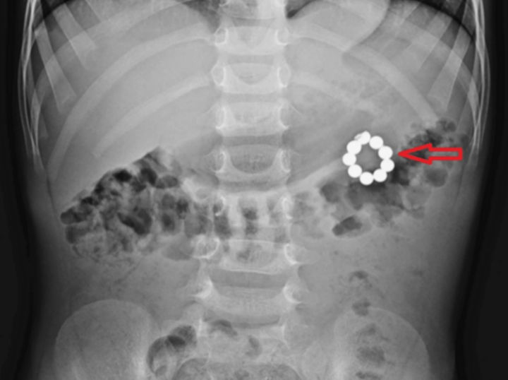 [서울=뉴시스] 방글라데시에서 5세 남아가 자석 팔찌를 삼켜 긴급 수술을 받았다. (사진=큐레우스 제공)