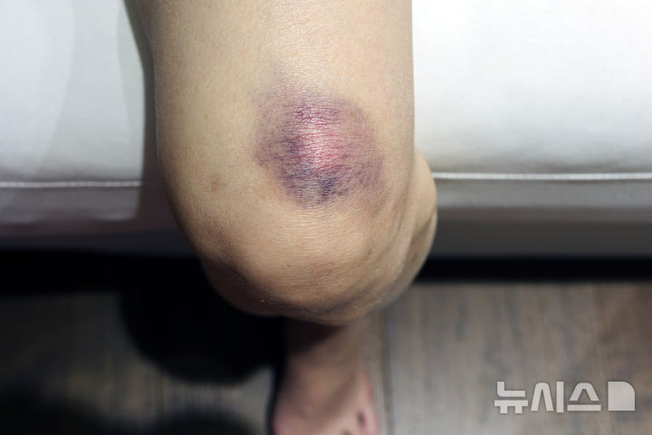 [서울=뉴시스] 급성골수성백혈병은 정상적인 백혈구의 생산을 방해하는 비정상적인 세포가 적색골수에서 생성, 축적되는 혈액암을 말한다. (사진= 유토이미지 제공)