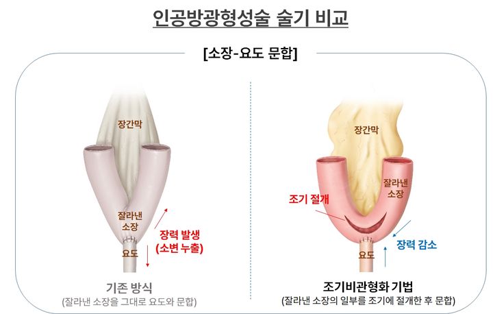 [서울=뉴시스] 28일 분당서울대학교병원에 따르면 오종진 비뇨의학과 교수팀은 소변 누출(요누출) 합병증을 낮출 수 있는 수술 방법을 제시했다. (사진=분당서울대병원 제공) 2026.04.28. photo@newsis.ocm *재판매 및 DB 금지