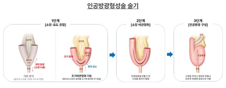 [서울=뉴시스] 28일 분당서울대학교병원에 따르면 오종진 비뇨의학과 교수팀은 소변 누출(요누출) 합병증을 낮출 수 있는 수술 방법을 제시했다. (사진=분당서울대병원 제공) 2026.04.28. photo@newsis.ocm *재판매 및 DB 금지
