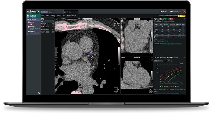 [서울=뉴시스] 코어라인소프트는 자사 개발한 관상동맥 석회화 의료 인공지능(AI) 에이뷰(AVIEW) CAC가 미국 보험 청구 체계에 첫 진입했다고 30일 밝혔다. (사진=코어라인소프트 제공) 2026.04.30. photo@newsis.com *재판매 및 DB 금지
