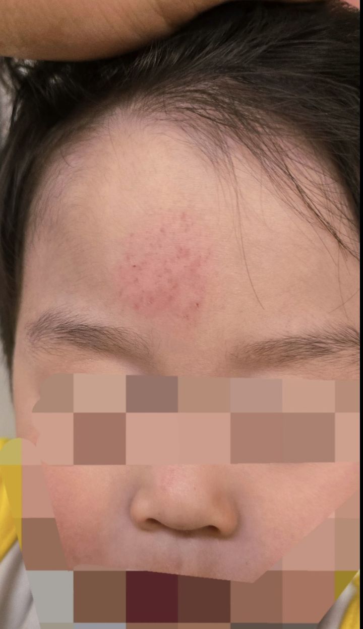 [서울=뉴시스]인천의 한 공원에서 지난 4일 2살 남자아이가 일면식도 없는 남성에게 폭행을 당해 이마에 타박상을 입은 모습. (사진출처: 스레드) 2026.05.05.