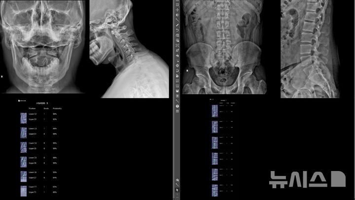 [서울=뉴시스] 강직척추염 환자의 엑스레이(X-ray) 사진을 이승훈 교수가 개발한 인공지능(AI) 딥러닝 모델을 적용하면, 경추와 요추의 척추체 모서리 24개 부위를 자동분석해 염증 정도의 정량화가 6초만에 가능하다. (사진= 한양대학교병원 제공) 