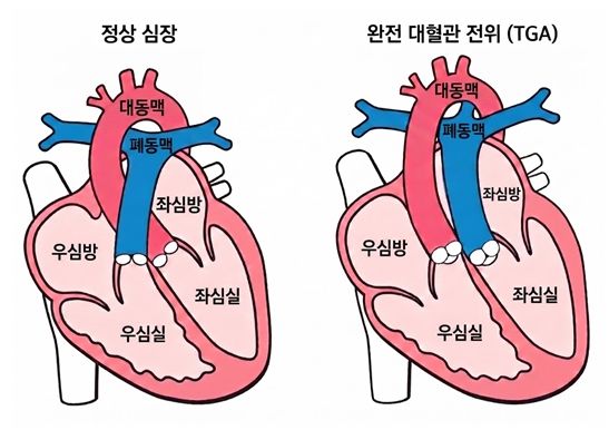 [서울=뉴시스] 서울대병원에 따르면 이상윤 소아청소년과 교수와 조화진 전남대병원 소아청소년과 교수 연구팀은 1990년부터 2015년까지 국내 10개 상급종합병원에서 대동맥 전환술을 받은 환자 1125명을 대상으로 최대 30년(중앙값 14.5년)에 걸친 추적 연구를 수행한 결과를 8일 발표했다. (사진=서울대병원 제공) 2026.05.08. photo@newsis.com *재판매 및 DB 금지