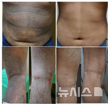 [서울=뉴시스] 한림대학교강남성심병원 중증아토피피부염 환자의 초진 변병 사진(좌) 6개월 단계적 치료 후 호전된 사진(우). (사진= 한림대학교강남성심병원 제공) 