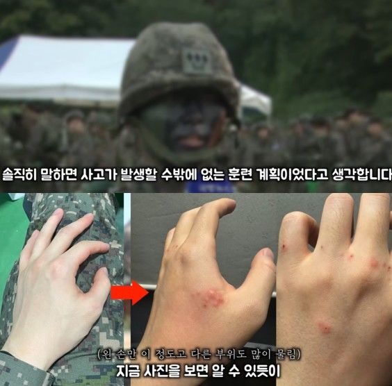 [서울=뉴시스] 예비군 사망 사고 부대의 부실한 훈련 환경을 폭로한 유튜버 '김토르'가 현장 상황을 설명하며 훈련 중 해충에 물려 상처가 가득해진 손 사진을 공개했다. (사진 출처=유튜브 채널 '김토르' 캡처)