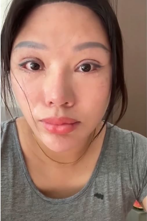 [서울=뉴시스] 쌍꺼풀 수술 부작용으로 눈을 감지 못하는 장애를 얻은 중국 여성이 6년간의 법적 분쟁 끝에 합의금 일부를 반환하게 된 사연이 온라인에서 논란을 낳고 있다. (사진=웨이보)