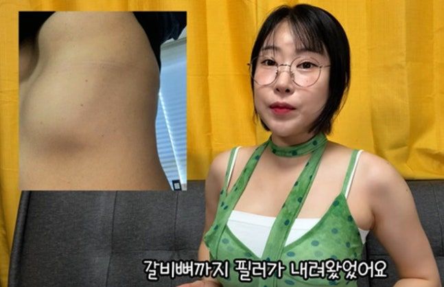 가슴 성형 이세영 "필러 부작용으로 가슴 4개 됐다"
