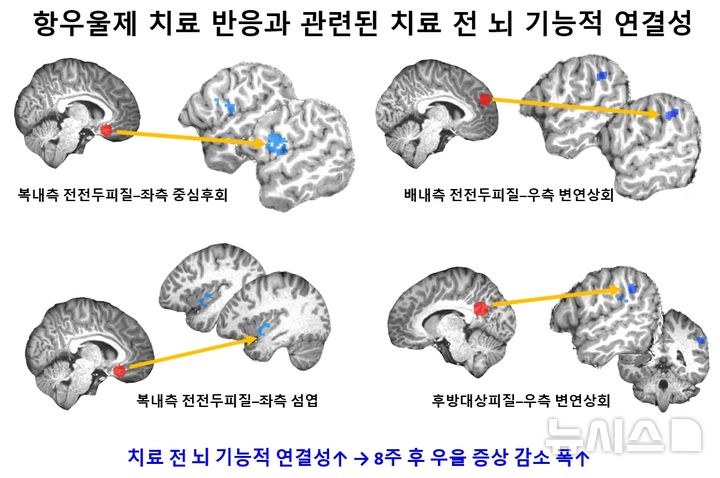 [서울=뉴시스] 항우울제 치료 전 기본모드네트워크(붉은색)와 감각운동·인지조절 관련 뇌 영역(파란색) 간 기능적 연결성이 높을수록 8주 치료 후 우울 증상 감소 폭이 컸다. (사진= 서울대병원 제공)
