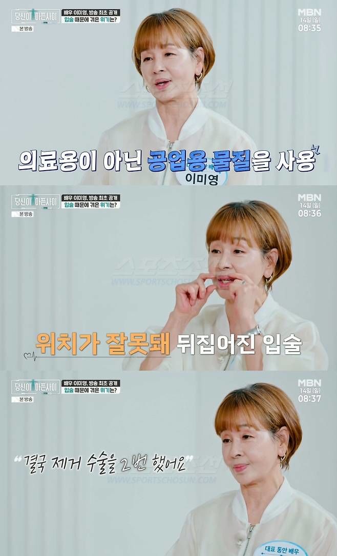 이미영 "입술에 공업용 물질 필러…인생 최악 실수"