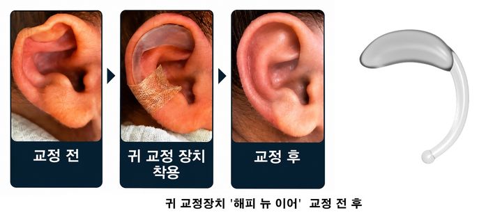 '울산대병원 개발·특허' 신생아 귀 교정장치 500례 돌파