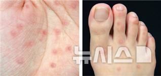 [서울=뉴시스] 수족구병은 면역력이 약한 5세 이하 영유아에서 흔히 발생하며 5월부터 시작돼 8월에 정점을 보이는 대표적인 여름철 감염병이다.영유아에 손등·발등, 손바닥·발바닥, 엉덩이 등에 붉은 물집 형태의 발진이 나타나는 것이 특징이다. (사진= 서울대병원 제공)
