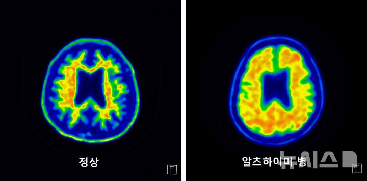 [서울=뉴시스] 아밀로이드 PET 영상. (사진= 서울성모병원 제공)