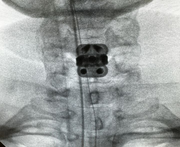 환자의 수술 후 전후방 엑스레이(X-ray) 이미지. (사진=엘앤케이바이오)&nbsp;&nbsp;&nbsp;&nbsp; *재판매 및 DB 금지