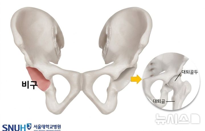 [서울=뉴시스] 골반뼈 구조. (사진= 서울대학교병원 제공)