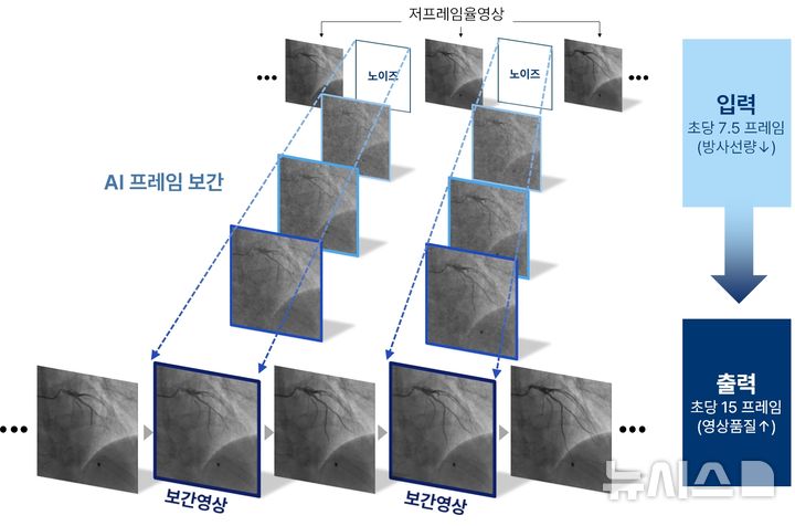 [서울=뉴시스] 관상동맥조영술 프레임 보간 모델 Angio-FILM 모식도. (사진= 분당서울대병원 제공)