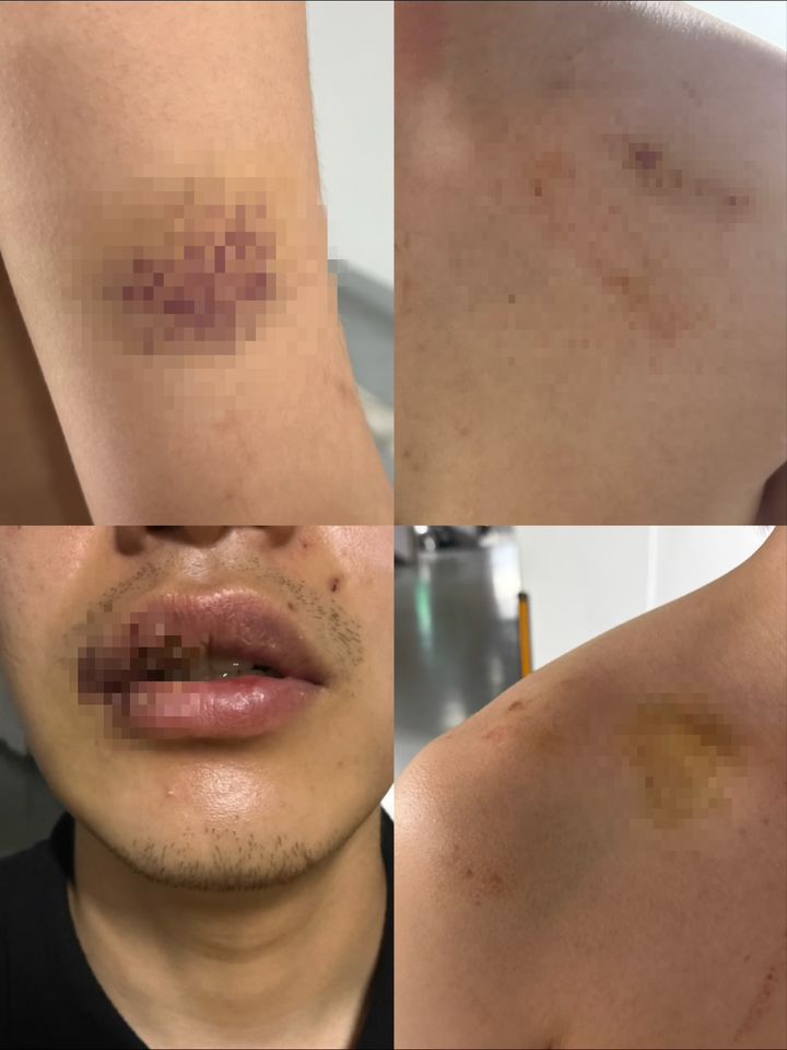 [경산=뉴시스] 김드보라 인턴기자 = 경산 친구 살해 사건의 또 다른 피해자 A씨의 몸에 다양한 상처와 멍이 남아있다. (제공=피해자 유가족측) *재판매 및 DB 금지