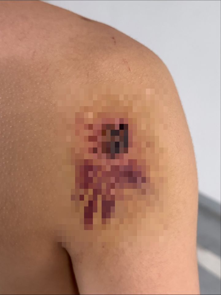 [경산=뉴시스] 김드보라 인턴기자 = 경산 친구 살해 사건 당시 현장에 있었던 또 다른 피해자 A씨 몸에 난 멍자국.(제공=피해자 유가족측) *재판매 및 DB 금지