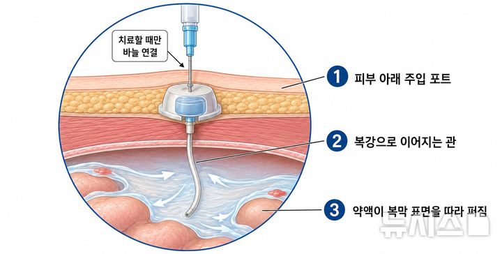 [서울=뉴시스] 복강 내 파클리탁셀 주입 치료 개념도. (사진= 분당서울대병원 제공)