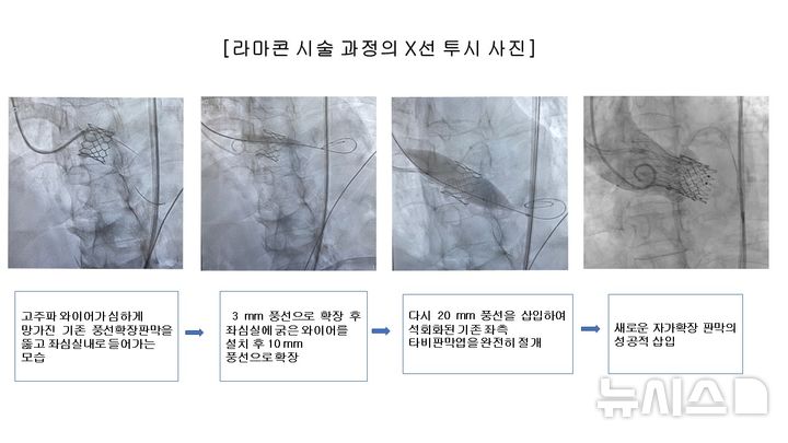 [서울=뉴시스] 시술과정 X레이 사진. (사진= 서울성모병원 제공)