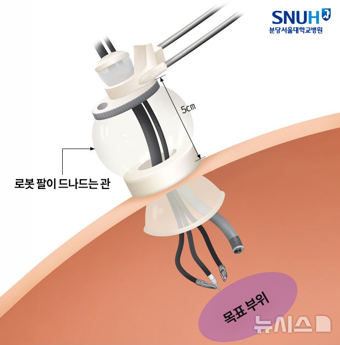 [서울=뉴시스] 보조 장치를 활용해 로봇 팔이 드나드는 관을 피부 표면에서 약 5㎝ 위로 띄워 고정했다. (사진= 분당서울대병원 제공)