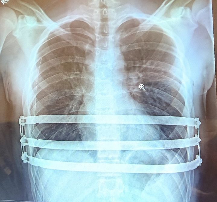 자로주스키 박사가 팩투스(Pectus) 수술을 집도 한 후 촬영한 흉부 X-ray 영상 이미지. (사진=엘앤케이바이오) *재판매 및 DB 금지