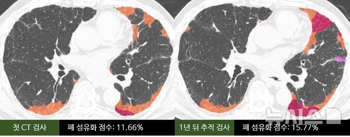 [서울=뉴시스] AI 기반 CT 정량 분석 기술로 섬유화가 진행된 폐 영역을 인식해 75세 남성 특발성 폐섬유증 환자의 1년간 폐 섬유화 진행 정도를 비교한 모습. 첫 검사 당시 폐 섬유화 점수는 11.66%이었으나 1년 뒤 추적 검사에서 15.77%로 증가했다. 망상 음영(주황색)은 9.34%에서 11.39%로, 벌집 모양 음영(분홍색)은 2.32%에서 4.38%로 늘었다. (사진= 서울아산병원 제공)