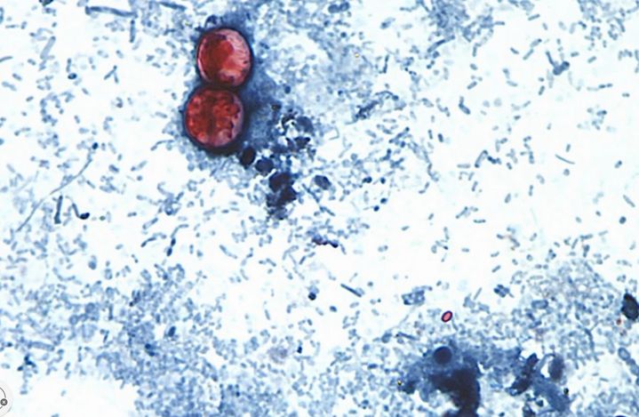 [AP/뉴시스] 미국 질병통제예방센터(CDC)에서 제공한 현미경으로 촬영한 사진. 포르말린 용액으로 처리하고 사프라닌으로 염색한 신선한 대변 샘플의 사이클로스포리아 카예타넨시스오오시스트.2027.08.04. *재판매 및 DB 금지