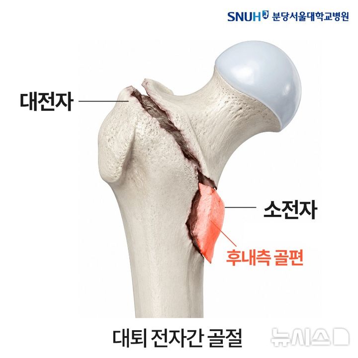 [서울=뉴시스] 불안정성 대퇴 전자간 골절. 대전자와 소전자의 사이가 부러질 때 후내측 골편도 같이 떨어지면 예후가 더 좋지 않다고 해, 불안정한 대퇴 골절 중 하나로 평가한다. (사진= 분당서울대병원 제공)