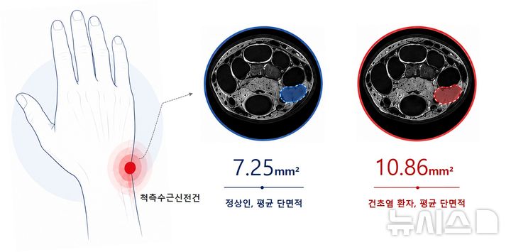 [인천=뉴시스] 척측수근신전건 건초염 환자와 정상인의 힘줄 단면적 MRI 비교. (사진=국제성모병원 제공) 2026.08.06. photo@newsis.com